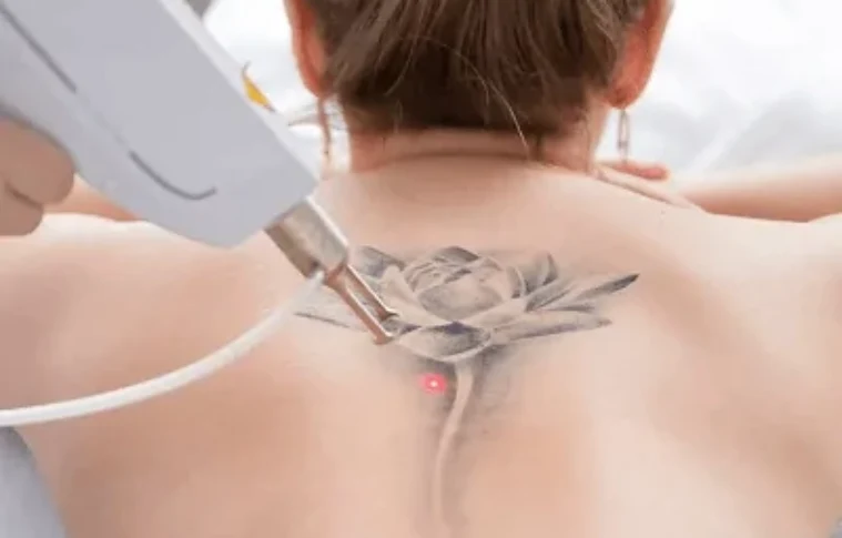 Laser Tattoo Removal in Dubai: Everything You Need to Know