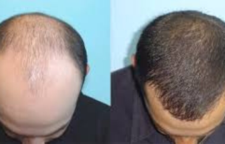 FUE Hair Transplant: The Modern Solution for Hair Loss