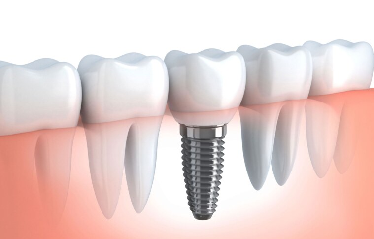 Why More People Are Choosing Dental Implants Abroad for Affordable and Quality Care