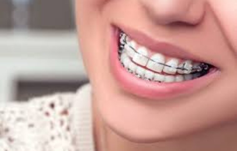 The Top 7 Long-Term Health Advantages of Braces!