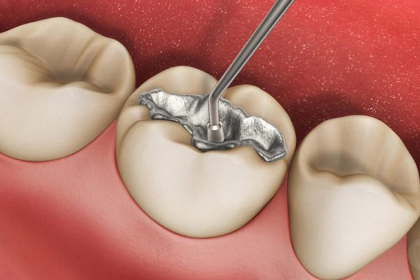 Preventing Damage to Your Dental Tooth Filling