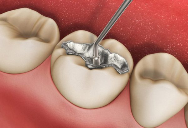 Preventing Damage to Your Dental Tooth Filling