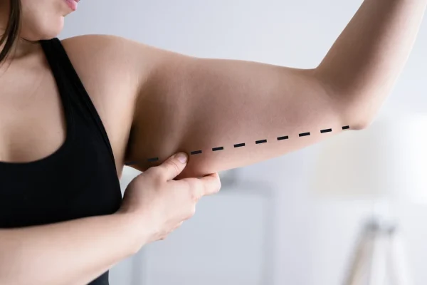 What Are the Benefits of Brachioplasty Surgery?