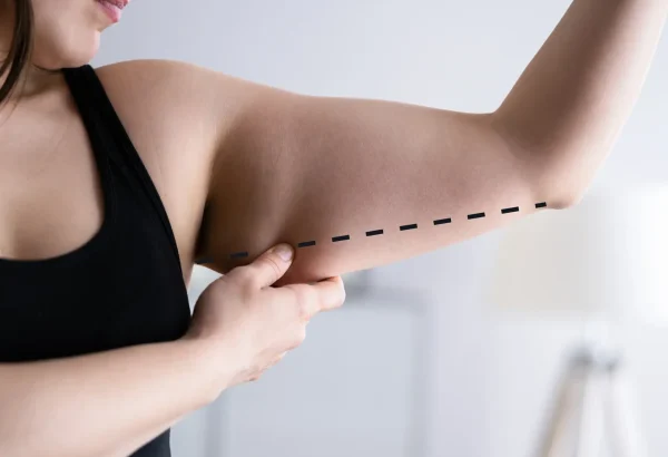 What Are the Benefits of Brachioplasty Surgery?