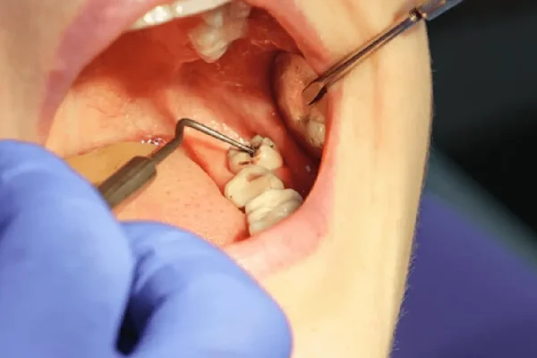 What is Tooth Removal and Why is It Necessary?