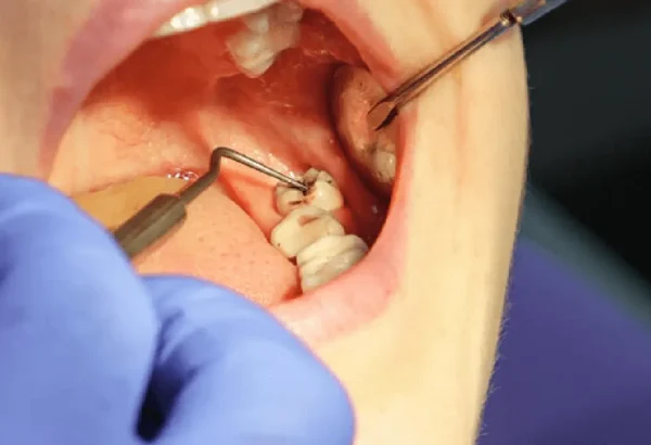 What is Tooth Removal and Why is It Necessary?