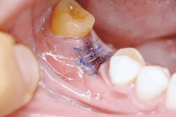 What is Tooth Removal and Why is It Necessary?