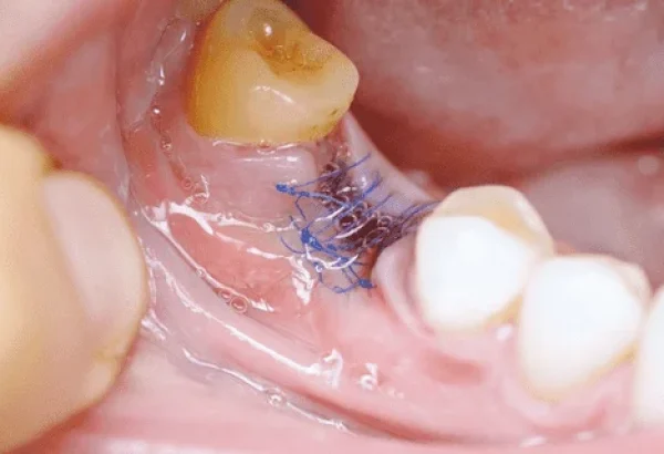 What is Tooth Removal and Why is It Necessary?