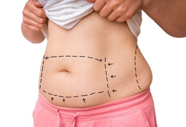 Is a Tummy Tuck Permanent?