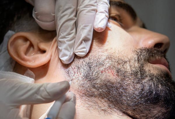 Is Beard Hair Transplant Suitable for People With Alopecia?