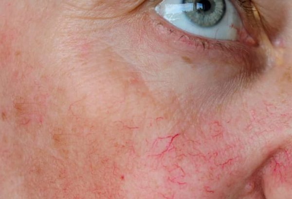 Is Facial Capillary Treatment Safe for Sensitive Skin?