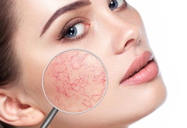 Who Is an Ideal Candidate for Facial Capillary Removal Treatment?