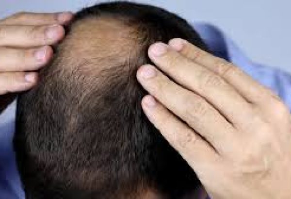 How Long Does Recovery Take After Crown Hair Transplant?
