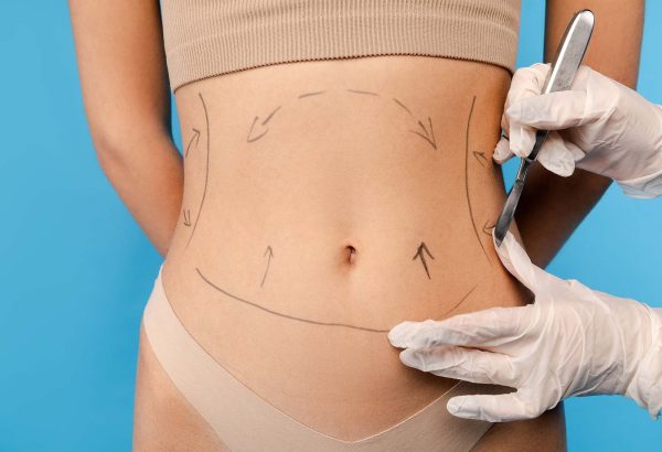 Who Is an Ideal Candidate for Liposuction Treatment?