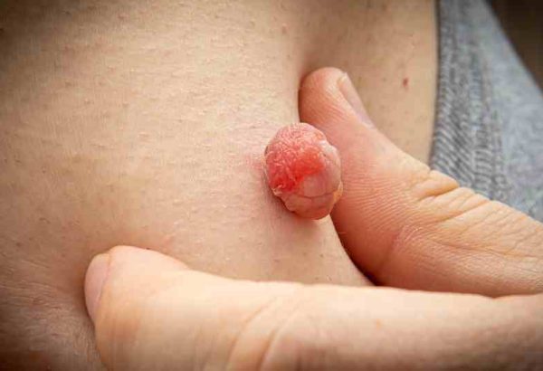 Does Skin Tag Removal Leave Any Scars?