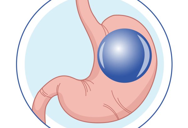 Does Allurion Gastric Balloon Clinic support healthier lifestyle shift?
