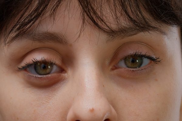 Best Non-Surgical Eye Bag Removal Solutions