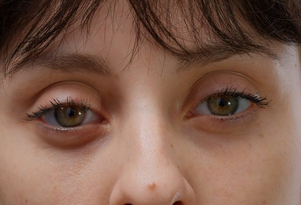 Best Non-Surgical Eye Bag Removal Solutions