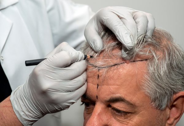 Can Hair Transplant Rebuild A Youthful Hairline Shape?