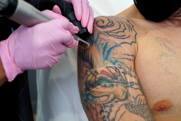 Can Laser Tattoo Removal Fade Tattoos Without Redness?