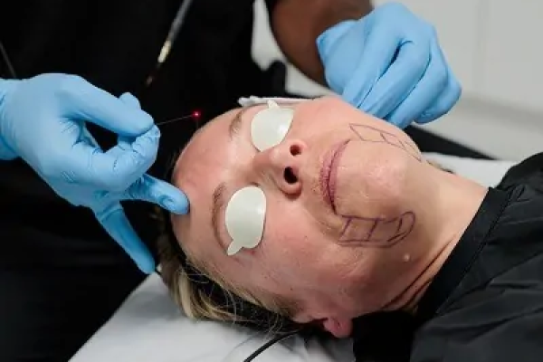 Endolift for Skin Rejuvenation: A Complete Guide