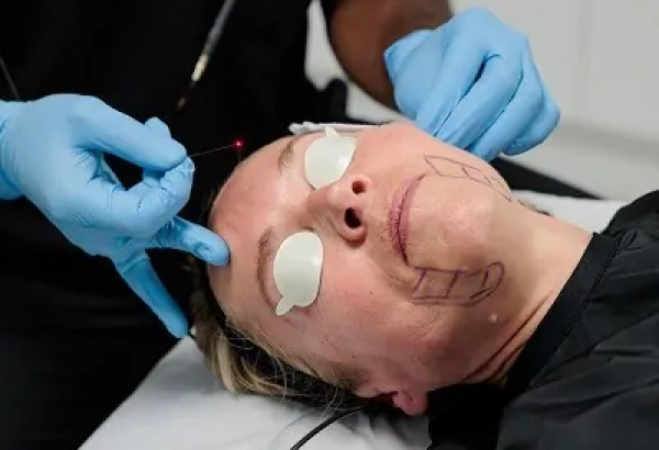 Endolift for Skin Rejuvenation: A Complete Guide