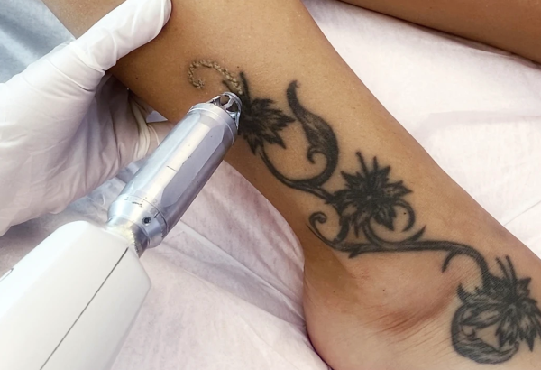 How Many Sessions Are Needed for Laser Tattoo Removal Results?