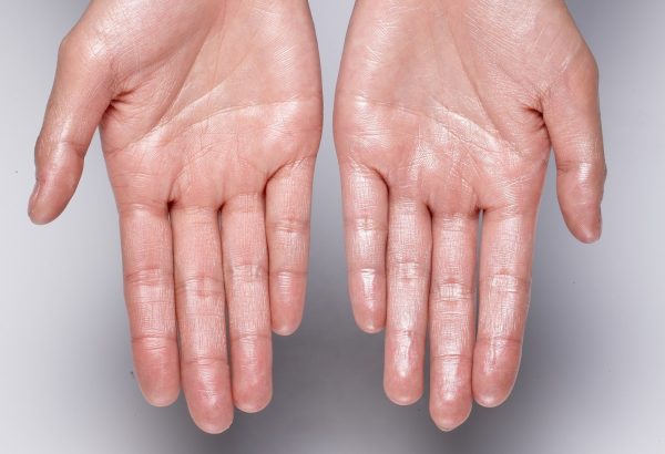 Is Hyperhidrosis Treatment Effective for Hands and Feet Sweating?