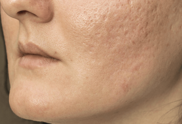 How Does Rf Differ From Laser Treatment for Acne Scars?