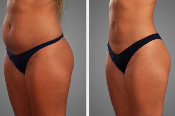Vaser 4D Liposuction Results: What to Expect