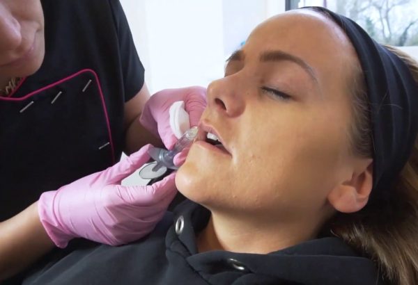 Why Are Lip Fillers a Top Choice for Fuller Lip Definition?