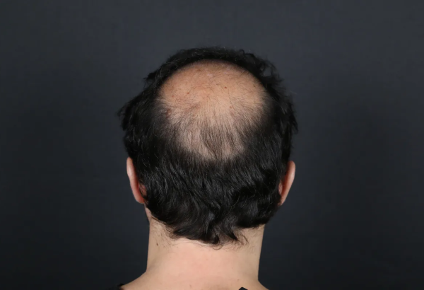 How Does Crown Hair Transplant Differ From Frontal Hairline Transplant?