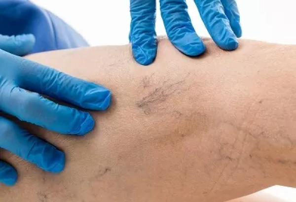 How Is Varicose Vein Treatment Performed?