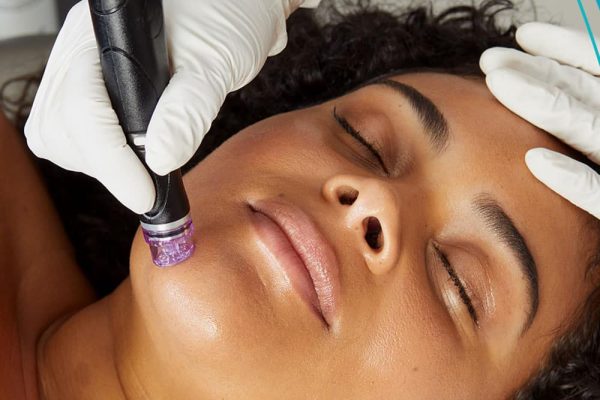 Does Hydrafacial Improve Hyperpigmentation?