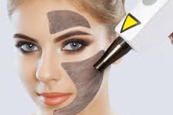 How Does a Laser Carbon Peel Work?