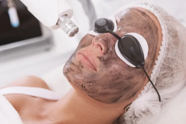 Who is the Best Candidate for Spectra Carbon Peel?