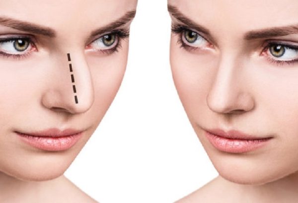 جراحة تجميل الأنف في دبي: أمان تام ونتائج مضمونة