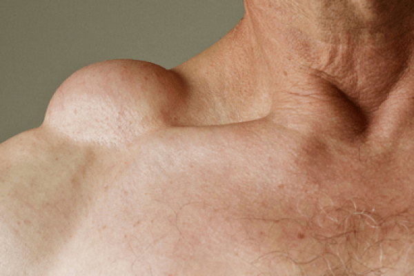 Lipoma Treatment and Understanding Fatty Growths
