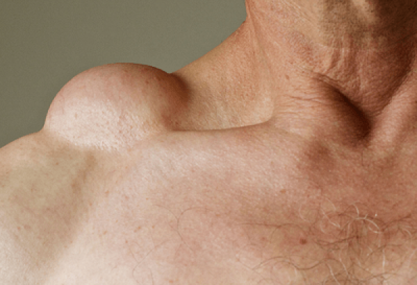 Lipoma Treatment and Understanding Fatty Growths