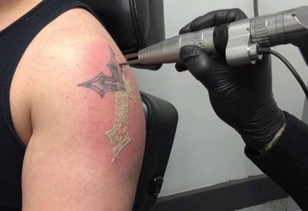 Can Laser Tattoo Removal Completely Remove Tattoos?