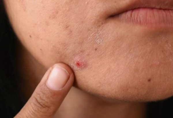 Can Pimples Treatment Heal Acne-Prone Skin Effectively?