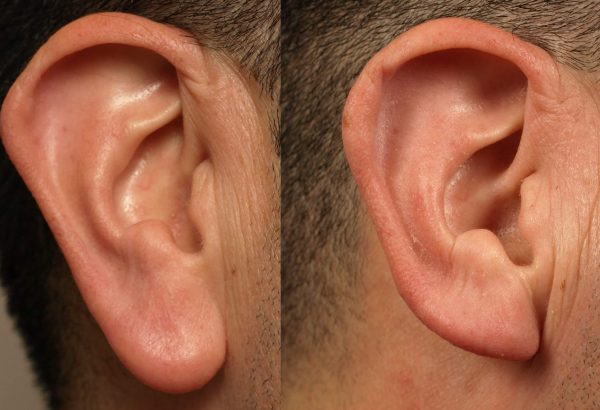 Earlobe Correction for Fully Torn Earlobes