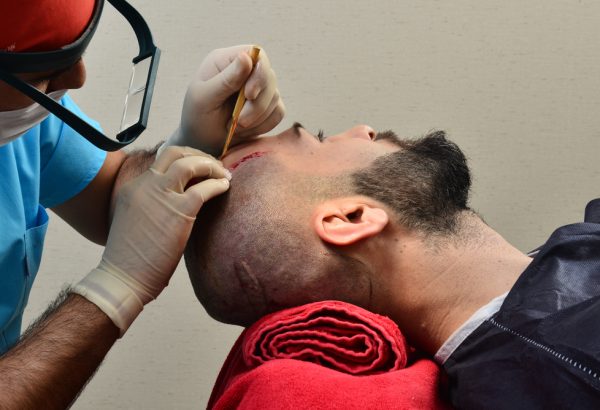 How Can Hair Transplant Increase Hair Density Effectively?