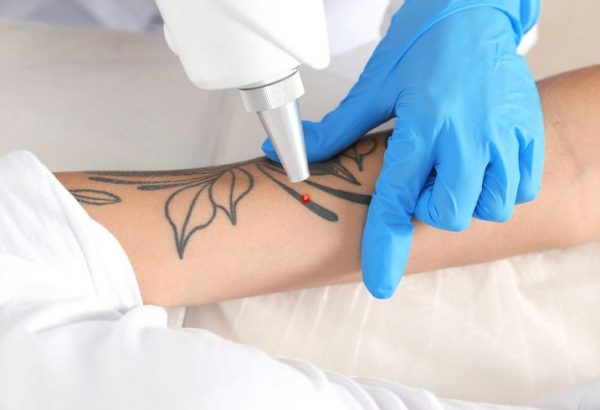 How Does Laser Tattoo Removal Work Beneath the Skin?