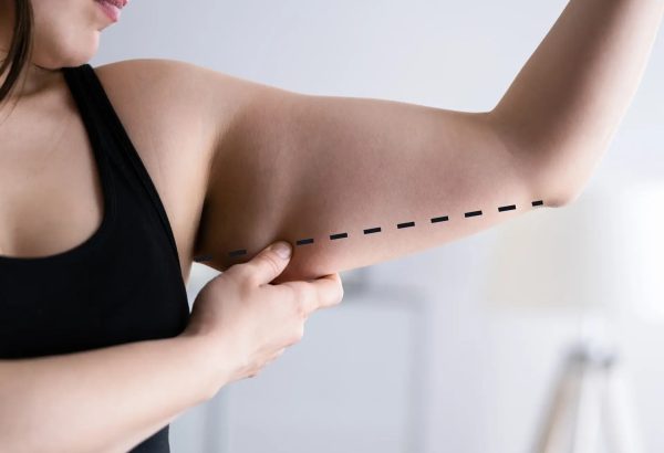 Is Arm Lift Surgery Safe?