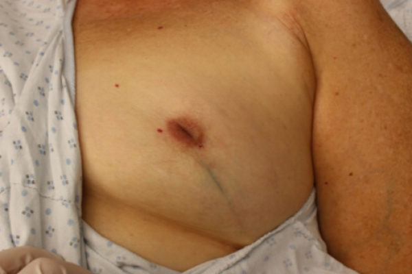 Inverted Nipple Surgery for Bilateral Cases Explained