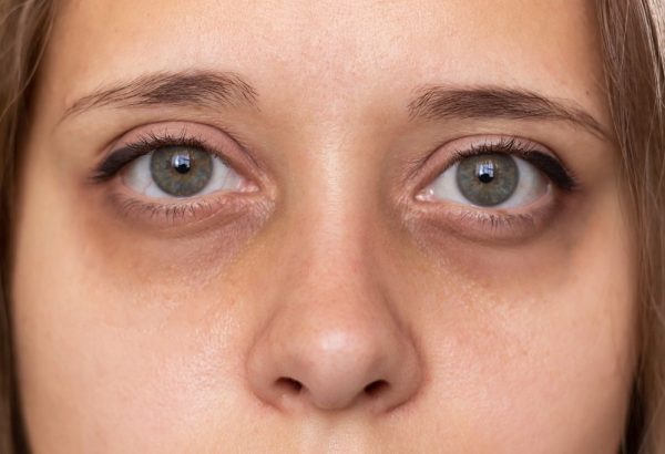 Are Dark Circle Treatments Safe?