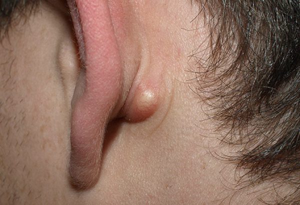 Lipoma Treatment Cost Breakdown: What You Should Know
