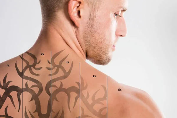 Is PicoSure Laser Tattoo Removal Quick and Gentle?