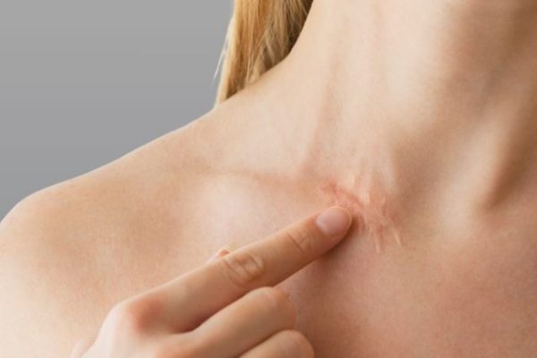 Surgical Scar Revision vs Chemical Peels: Which Is Better?